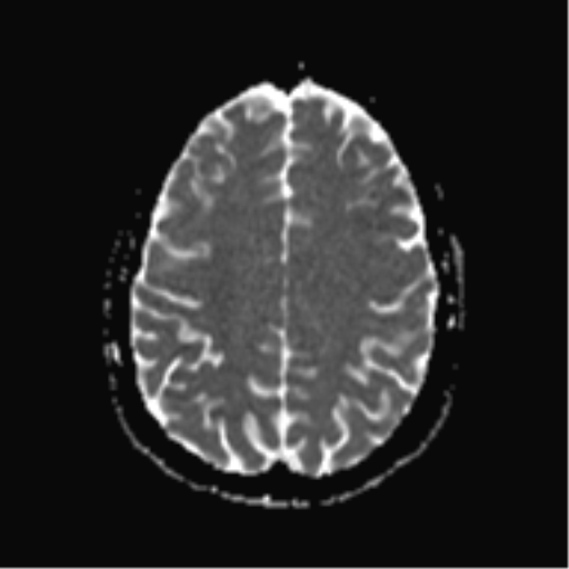 File:Cerebral cavernoma and development venous anomaly (Radiopaedia 37603-39482 Axial ADC 16).png