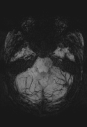 File:Cerebral cavernoma and development venous anomaly (Radiopaedia 37603-39482 Axial SWI MIP 10).png