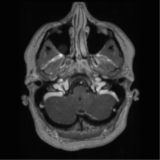 Cerebral cavernoma and development venous anomaly (Radiopaedia 37603-39482 Axial T1 C+ 13).png