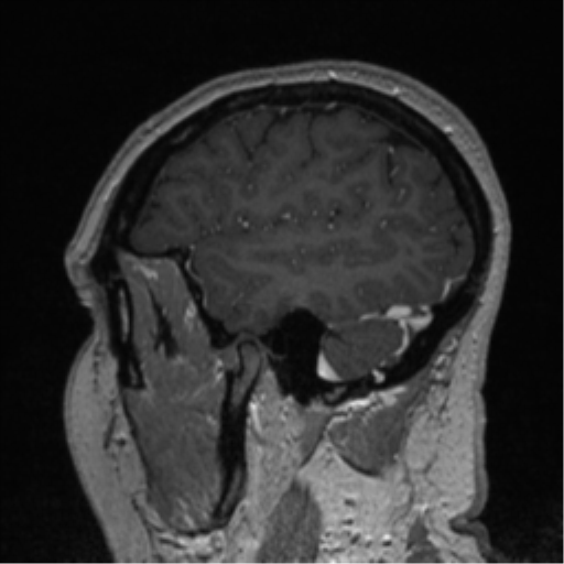 Cerebral cavernoma and development venous anomaly (Radiopaedia 37603-39482 Sagittal T1 C+ 21).png