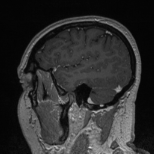Cerebral cavernoma and development venous anomaly (Radiopaedia 37603-39482 Sagittal T1 C+ 75).png