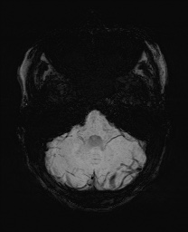 Cerebral cavernous venous malformation (Radiopaedia 70008-80021 Axial SWI 13).jpg