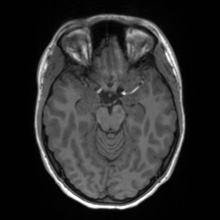 Cerebral cavernous venous malformation (Radiopaedia 70008-80021 Axial T1 27).jpg