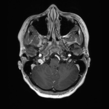 Cerebral cavernous venous malformation (Radiopaedia 70008-80021 Axial T1 C+ 11).jpg