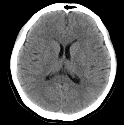 File:Cerebral cavernous venous malformations (Radiopaedia 48117-52945 Axial non-contrast 19).png
