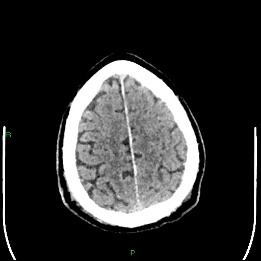 Cerebral contusions (Radiopaedia 33868-35039 Axial non-contrast 181).jpg