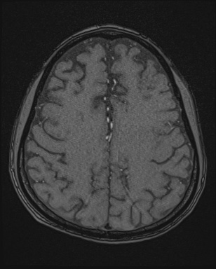 Cerebral embolic infarcts (embolic shower) (Radiopaedia 72391-82921 Axial MRA 148).jpg