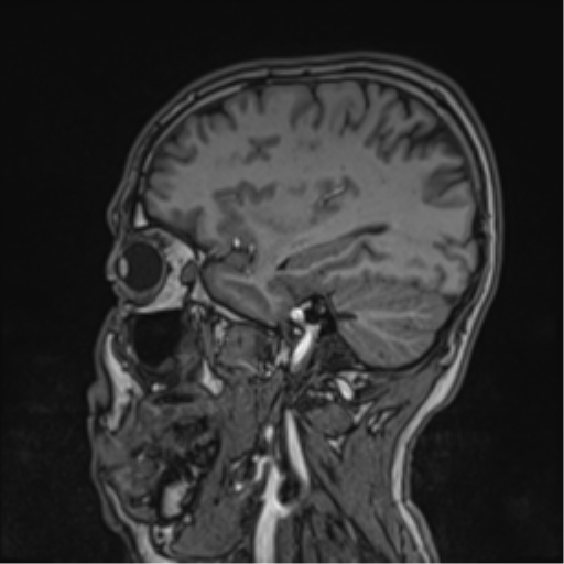 Cerebral fat embolism (Radiopaedia 57697-64639 Sagittal T1 35).png