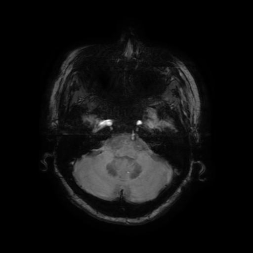 Cerebral metastases - melanoma (Radiopaedia 80972-94522 Axial SWI 23).jpg