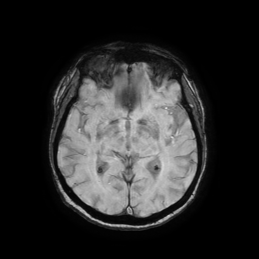 Cerebral metastases - melanoma (Radiopaedia 80972-94522 Axial SWI 48).jpg