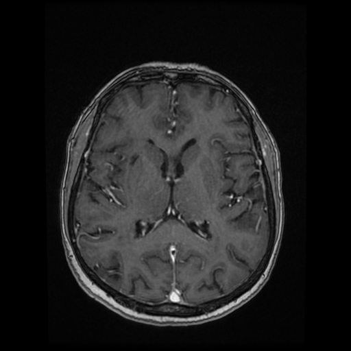 Cerebral metastases - melanoma (Radiopaedia 80972-94522 Axial T1 C+ 57).jpg