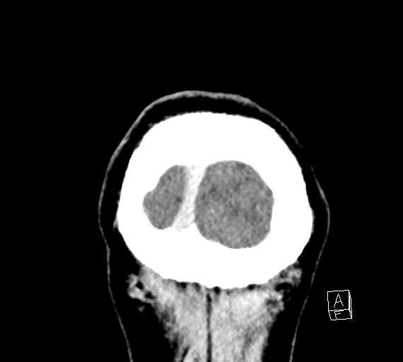 Cerebral metastases - testicular choriocarcinoma (Radiopaedia 84486-99855 D 60).jpg