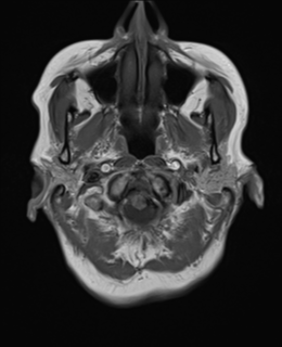 File:Cerebral metastasis (Radiopaedia 46744-51248 Axial T1 1).png