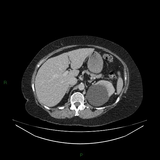 Cerebral metastasis from renal cell carcinoma (Radiopaedia 82306-96378 A 49).jpg