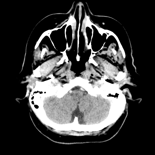Cerebral metastasis to basal ganglia (Radiopaedia 81568-95412 Axial C+ delayed 12).png