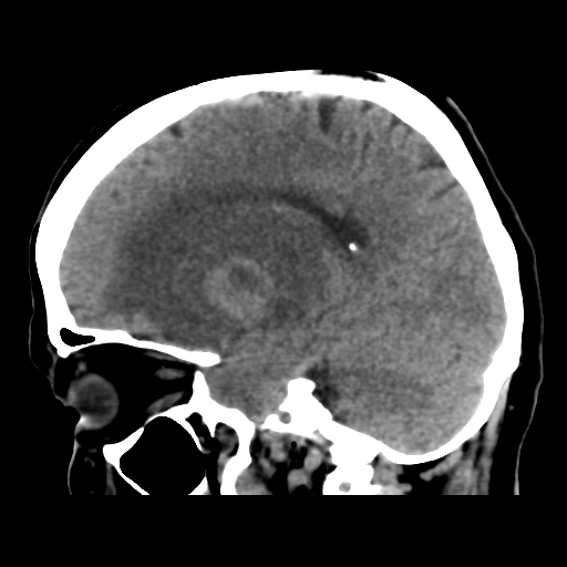 Cerebral metastasis to basal ganglia (Radiopaedia 81568-95412 E 25).png