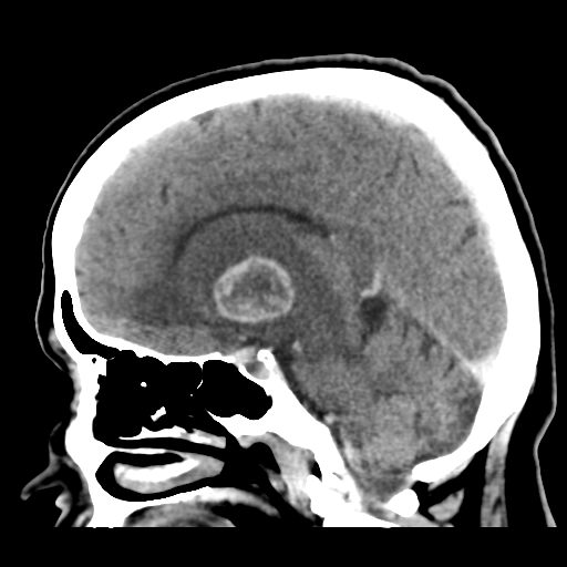 Cerebral metastasis to basal ganglia (Radiopaedia 81568-95412 Sagittal C+ delayed 27).png