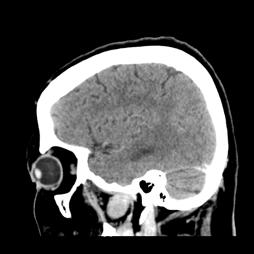 Cerebral metastasis to basal ganglia (Radiopaedia 81568-95412 Sagittal C+ delayed 43).png