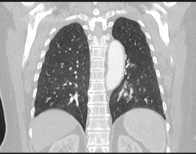 Cerebral metastasis to basal ganglia (Radiopaedia 81568-95414 Coronal lung window 61).png