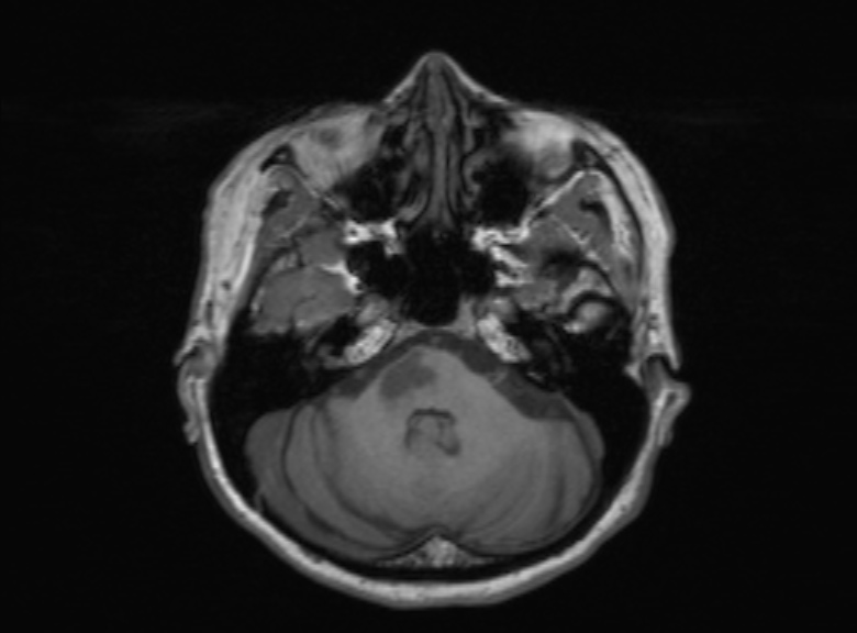 Cerebral ring enhancing lesions - cerebral metastases (Radiopaedia 44922-48817 Axial T1 301).jpg