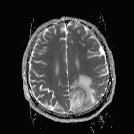 File:Cerebral toxoplasmosis (Radiopaedia 43956-47461 Axial ADC 14).jpg