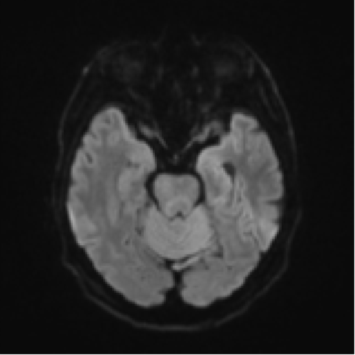 Cerebral toxoplasmosis (Radiopaedia 54575-60804 Axial DWI 45).png