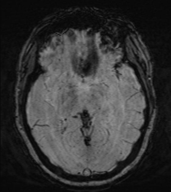 Cerebral venous infarct (Radiopaedia 53627-59685 Axial SWI 25).jpg