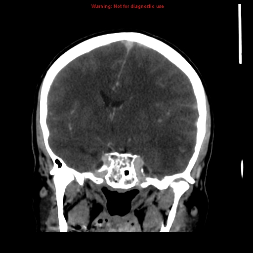 Cerebral venous infarction (Radiopaedia 12404-20735 B 38).jpg