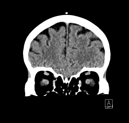 Cerebral venous infarction with hemorrhage (Radiopaedia 65343-74381 Coronal non-contrast 9).jpg