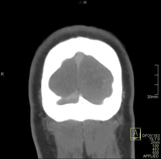 Cerebral venous sinus thrombosis (Radiopaedia 91329-108965 Coronal venogram 83).jpg