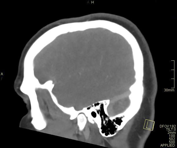 Cerebral venous sinus thrombosis (Radiopaedia 91329-108965 Sagittal venogram 15).jpg