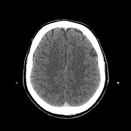 File:Cerebral venous thrombosis (CVT) (Radiopaedia 77524-89685 Axial non-contrast 34).jpg