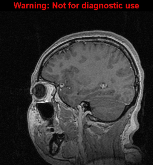 Cerebral venous thrombosis (Radiopaedia 37224-39208 Sagittal T1 C+ 107).jpg