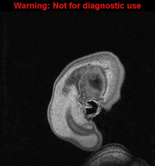 Cerebral venous thrombosis (Radiopaedia 37224-39208 Sagittal T1 C+ 5).jpg