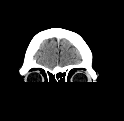 File:Cerebral venous thrombosis (Radiopaedia 38392-40467 Coronal non-contrast 6).png