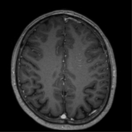 Cerebral venous thrombosis (Radiopaedia 38392-40469 Axial T1 C+ 55).png