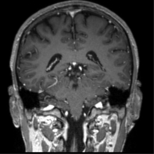 Cerebral venous thrombosis (Radiopaedia 38392-40469 Coronal T1 C+ 33).png