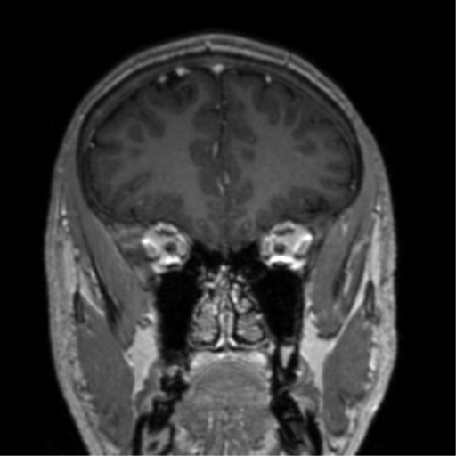 Cerebral venous thrombosis (Radiopaedia 38392-40469 Coronal T1 C+ 68).png