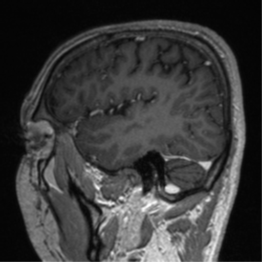 Cerebral venous thrombosis (Radiopaedia 38392-40469 Sagittal T1 C+ 68).png