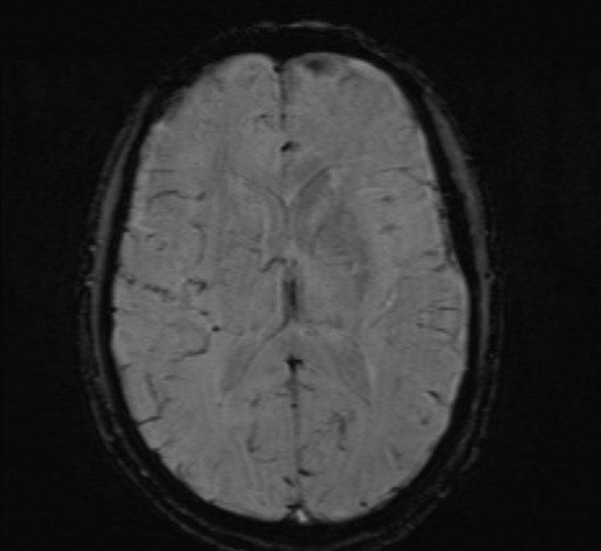 Cerebral venous thrombosis (Radiopaedia 71207-81504 Axial SWI 30).jpg