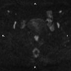 File:Cervical adenocarcinoma (Radiopaedia 65011-73985 Axial DWI 51).jpg