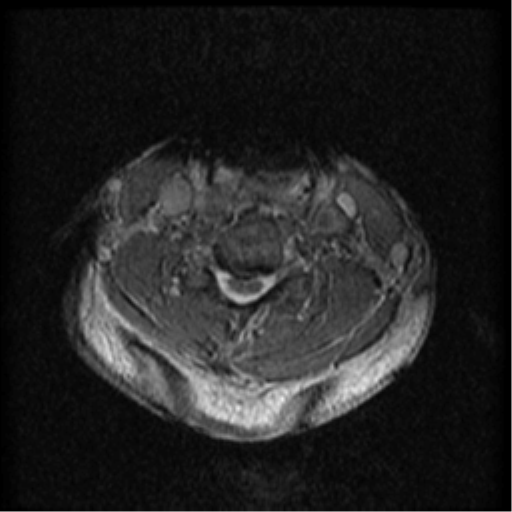Cervical canal stenosis with cord compression (Radiopaedia 34114-35374 Axial Gradient Echo 42).png