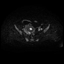 Cervical carcinoma (Radiopaedia 88010-104555 Axial DWI 34).jpg