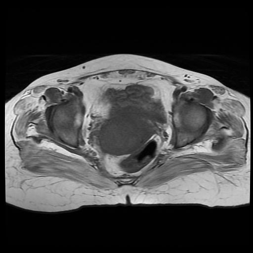 File:Cervical carcinoma (Radiopaedia 88010-104555 Axial T1 13).jpg