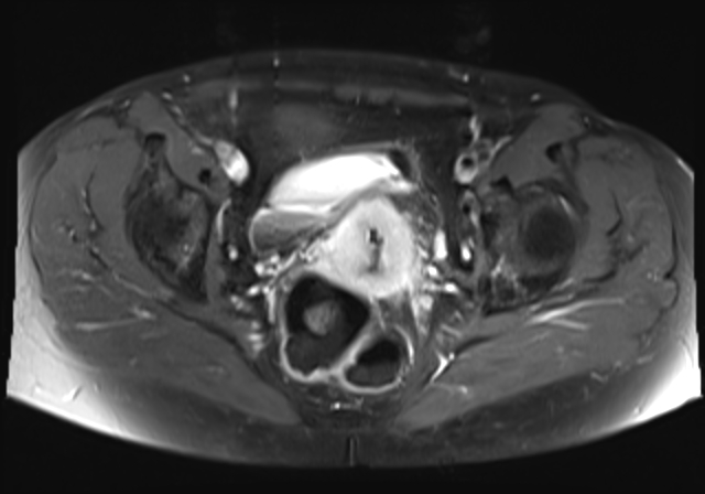 File:Cervical carcinoma (Radiopaedia 88312-104943 Axial T1 C+ fat sat 13).jpg
