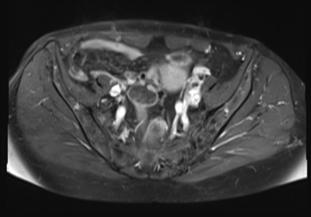 File:Cervical carcinoma (Radiopaedia 88312-104943 Axial T1 C+ fat sat 8).jpg