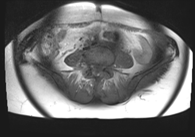 File:Cervical carcinoma (Radiopaedia 88312-104943 Axial T1 fat sat 1).jpg