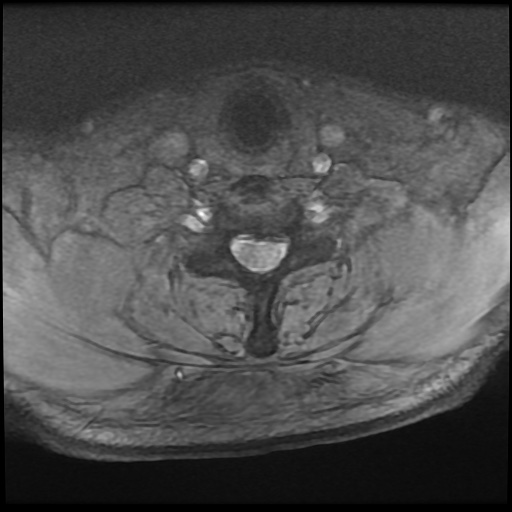 Cervical disc extrusion (Radiopaedia 59074-66364 F 46).jpg