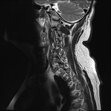 File:Cervical spinal neurofibroma in a patient with NF1 (Radiopaedia 58344-65465 Sagittal T2 1).jpg