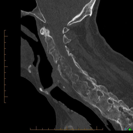 Cervical spine fracture - ankylosing spondylitis (Radiopaedia 76835-88706 Sagittal bone window 66).jpg